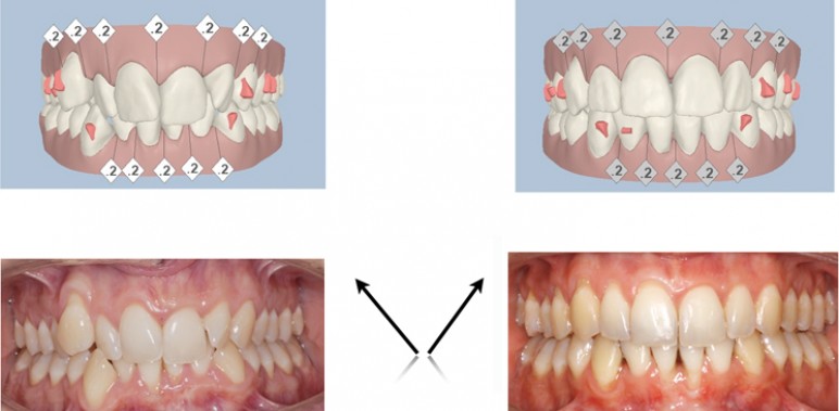 Faccette Dentali  Studio Dentistico Dott. Alberto Gentile